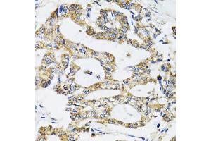 Immunohistochemistry of paraffin-embedded human colon carcinoma using SSBP1 antibody (ABIN5974202) at dilution of 1/100 (40x lens). (SSBP1 antibody)