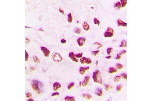Immunohistochemical analysis of Cullin 1 staining in human lung cancer formalin fixed paraffin embedded tissue section. (Cullin 1 antibody  (C-Term))