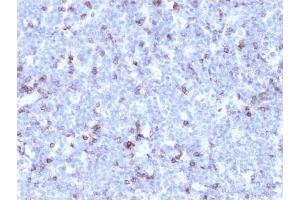 Formalin-fixed, paraffin-embedded human Lymphoma stained with CD43 Mouse Recombinant Monoclonal Antibody (rSPN/1094). (Recombinant CD43 antibody)