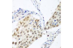 Immunohistochemistry of paraffin-embedded human lung cancer using BCAS2 antibody at dilution of 1:100 (40x lens). (BCAS2 antibody)