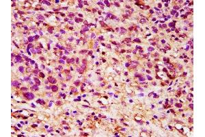 IHC image of ABIN7149816 diluted at 1:200 and staining in paraffin-embedded human ovarian cancer performed on a Leica BondTM system. (DPPA5 antibody  (AA 1-116))
