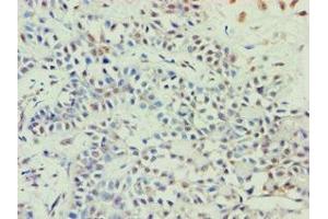 Immunohistochemistry of paraffin-embedded human breast cancer using ABIN7144924 at dilution of 1:100
