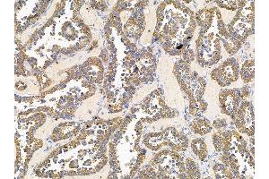 ABIN7095762 and ABIN7099824 at 1/100 staining human ovarian cancer by IHC-P. (ARFGEF1 antibody)
