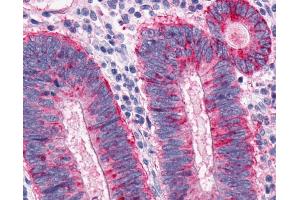 Anti-MCHR1 antibody IHC of human Colon, Carcinoma. (MCHR1 antibody  (N-Term))