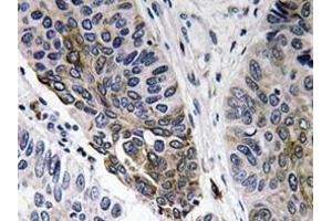 Immunohistochemistry analyzes of IgA antibody in paraffin-embedded human lung carcinoma tissue.