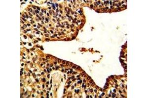 IHC analysis of FFPE human prostate carcinoma with VIP antibody (Vip antibody  (AA 139-167))