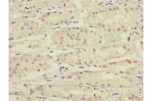 Immunohistochemistry of paraffin-embedded human gastric cancer using ABIN7157720 at dilution of 1:100 (KLF15 antibody  (AA 1-260))