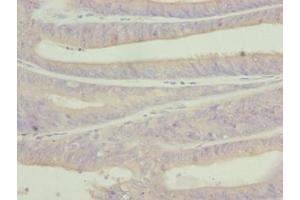 Immunohistochemistry of paraffin-embedded human endometrial cancer using ABIN7174916 at dilution of 1:100 (C9orf43 antibody  (AA 267-461))