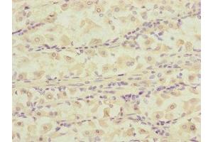 Immunohistochemistry of paraffin-embedded human gastric cancer using ABIN7150823 at dilution of 1:100 (DCTN6 antibody  (AA 1-190))