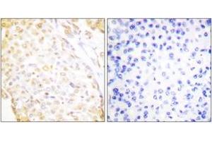 Immunohistochemistry analysis of paraffin-embedded human breast carcinoma, using NKX3. (NKX3-1 antibody  (AA 1-50))