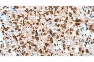 Immunohistochemistry of paraffin-embedded Human esophagus cancer using BNIP1 Polyclonal Antibody at dilution of 1:60 (BNIP1 antibody)