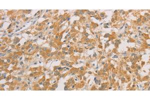 Immunohistochemistry of paraffin-embedded Human thyroid cancer tissue using ZWINT Polyclonal Antibody at dilution 1:50 (ZWINT antibody)