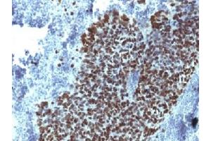 IHC testing of FFPE human prostate carcinoma with FOXA1 antibody (clone FOXA1/1514). (FOXA1 antibody  (AA 372-472))