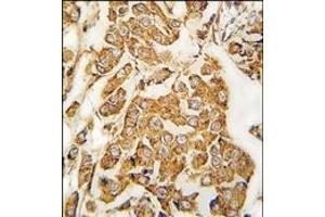 Formalin-fixed and paraffin-embedded human breast carcinoma tissue reacted with IGFBP3 Antibody, which was peroxidase-conjugated to the secondary antibody, followed by DAB staining. (IGFBP3 antibody  (Ser183))