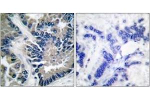 Immunohistochemistry analysis of paraffin-embedded human lung carcinoma tissue, using STAT2 (Ab-690) Antibody. (STAT2 antibody  (AA 656-705))