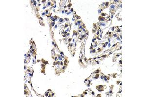 Immunohistochemistry of paraffin-embedded human lung cancer using FIGF antibody at dilution of 1:200 (400x lens).