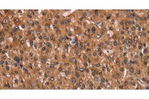 Immunohistochemistry of paraffin-embedded Human liver cancer using HINT1 Polyclonal Antibody at dilution of 1:30 (HINT1 antibody)