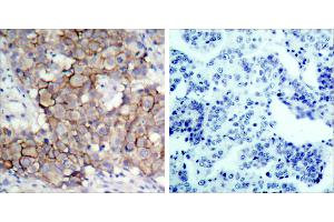 Immunohistochemical analysis of paraffin-embedded breast carcinoma, using HER2 (Phospho-Tyr877) Antibody. (ErbB2/Her2 antibody  (pTyr877))