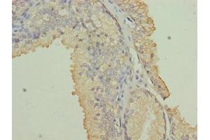 Immunohistochemistry of paraffin-embedded human prostate cancer using ABIN7161717 at dilution of 1:100 (NRARP antibody  (AA 1-114))