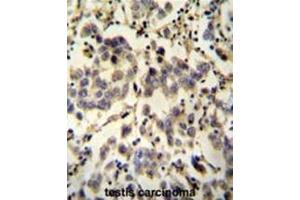C6orf58 antibody (Center) immunohistochemistry analysis in formalin fixed and paraffin embedded human testis carcinoma followed by peroxidase conjugation of the secondary antibody and DAB staining. (C6ORF58 antibody  (Middle Region))