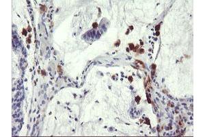 Immunohistochemical staining of paraffin-embedded Adenocarcinoma of Human colon tissue using anti-SDS mouse monoclonal antibody. (serine Dehydratase antibody)