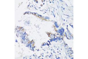 Immunohistochemistry of paraffin-embedded human lung cancer using IKBKE antibody. (IKKi/IKKe antibody  (AA 495-716))
