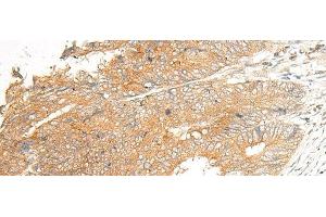 Immunohistochemistry of paraffin-embedded Human colorectal cancer tissue using C5AR2 Polyclonal Antibody at dilution of 1:25(x200) (GPR77 antibody)