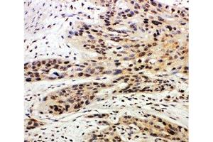 IHC-P: Caspase-14 antibody testing of human esophagus squama cancer tissue (CASP14 antibody  (AA 223-242))