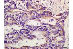 Formalin-fixed and paraffin embedded human rectal carcinoma labeled with Anti-CXCR2/CD182 Polyclonal Antibody, Unconjugated (ABIN732218) at 1:200 followed by conjugation to the secondary antibody and DAB staining (CXCR2 antibody  (AA 316-360))