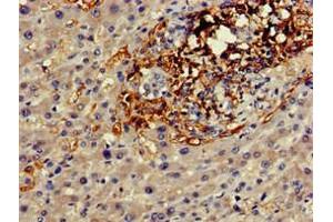 Immunohistochemistry of paraffin-embedded human liver cancer using ABIN7153601 at dilution of 1:100 (GJA8 antibody  (AA 286-432))