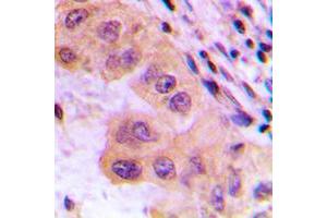 Immunohistochemical analysis of CTPS staining in human liver cancer formalin fixed paraffin embedded tissue section. (CTP Synthase antibody  (N-Term))