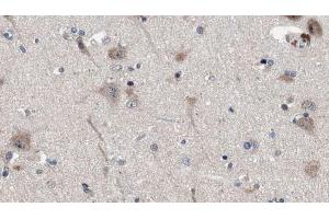 ABIN6272887 at 1/100 staining Human brain cancer tissue by IHC-P.