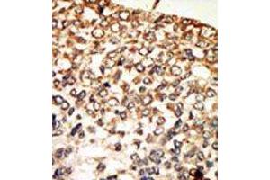 Formalin-fixed and paraffin-embedded human cancer tissue reacted with the primary antibody, which was peroxidase-conjugated to the secondary antibody, followed by AEC staining. (PRKACA antibody  (N-Term))