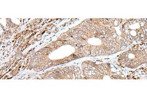 Immunohistochemistry of paraffin-embedded Human colorectal cancer tissue using ENPEP Polyclonal Antibody at dilution of 1:65(x200) (ENPEP antibody)