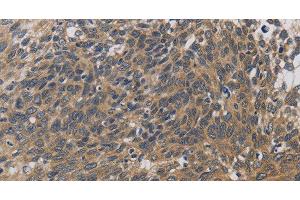 Immunohistochemistry of paraffin-embedded Human cervical cancer using EMC8 Polyclonal Antibody at dilution of 1:30 (COX4NB antibody)