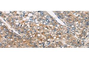 Immunohistochemistry of paraffin-embedded Human liver cancer tissue using CDKL4 Polyclonal Antibody at dilution of 1:45(x200) (CDKL4 antibody)