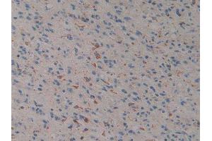 IHC-P analysis of Human Glioma Tissue, with DAB staining. (Prosaposin antibody  (AA 17-524))