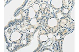 The image on the left is immunohistochemistry of paraffin-embedded Human thyroid cancer tissue using ABIN7192521(SLC7A11 Antibody) at dilution 1/35, on the right is treated with synthetic peptide. (SLC7A11 antibody)