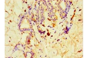 Immunohistochemistry of paraffin-embedded human breast cancer using ABIN7148491 at dilution of 1:100 (GPS1 antibody  (AA 222-491))