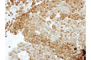 IHC-P Image Immunohistochemical analysis of paraffin-embedded PC14 xenograft, using ENO2, antibody at 1:100 dilution. (ENO2/NSE antibody)