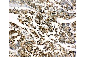 IHC-P: BiP antibody testing of human lung cancer tissue (GRP78 antibody  (C-Term))