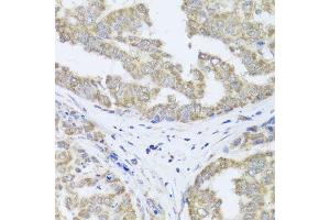 Immunohistochemistry of paraffin-embedded human liver cancer using TIMM10B antibody (ABIN5974609) at dilution of 1/100 (40x lens).