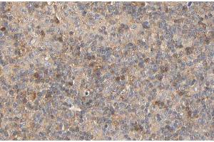 ABIN6267441 at 1/100 staining human Lymphoma tissue sections by IHC-P. (RPS6KB1 antibody  (pSer424))
