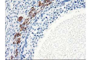 Immunohistochemical staining of paraffin-embedded Adenocarcinoma of Human ovary tissue using anti-ELK3 mouse monoclonal antibody.