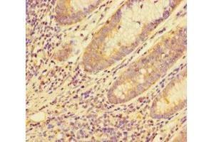Immunohistochemistry of paraffin-embedded human colon cancer using ABIN7159120 at dilution of 1:100