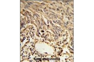 Formalin-fixed and paraffin-embedded human lung carcinoma reacted with EIF4A2 Antibody (C-term), which was peroxidase-conjugated to the secondary antibody, followed by DAB staining. (EIF4A2 antibody  (C-Term))