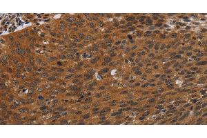 Immunohistochemistry of paraffin-embedded Human cervical cancer tissue using PNOC Polyclonal Antibody at dilution 1:40 (PNOC antibody)