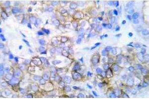 Immunohistochemistry (IHC) analyzes of HER2 pAb in paraffin-embedded human lung adenocarcinoma tissue. (ErbB2/Her2 antibody)