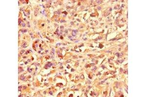 Immunohistochemistry of paraffin-embedded human melanoma using ABIN7155270 at dilution of 1:100 (KAT2B antibody  (AA 767-832))