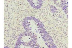 Immunohistochemistry of paraffin-embedded human ovarian cancer using ABIN7176735 at dilution of 1:100 (ZWINT antibody  (AA 1-277))